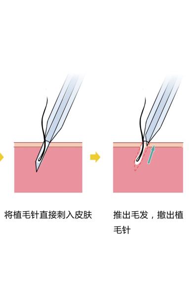 头发种植是怎么操作的,头发种植利弊有哪些呢