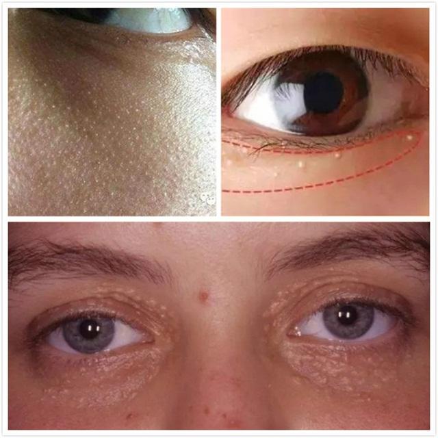 脸上频繁长脂肪粒怎么办,脸上长脂肪粒怎么办有效