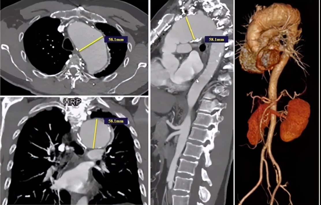 胡佳:升主动脉近端手术后新发弓部病变的腔内治疗