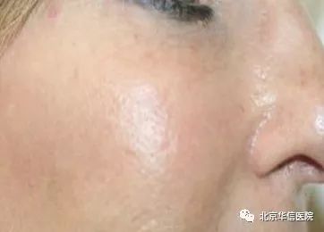 光子嫩肤唤醒肌肤活力重塑娇颜,光子嫩肤让你焕颜一新