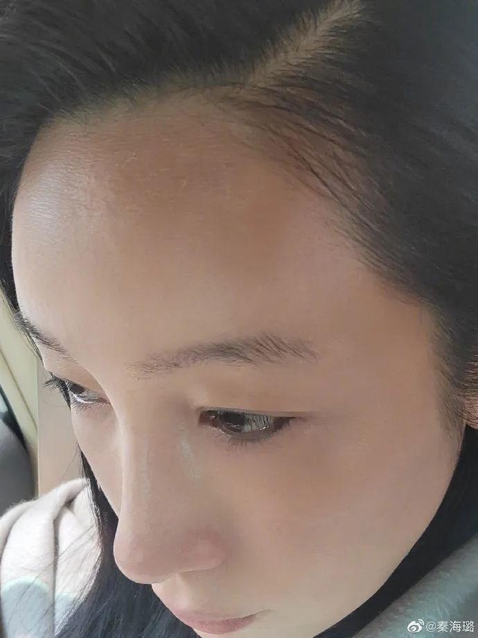 秦海璐晒到脱皮，陈伟霆晒成炭黑色，三角涂抹抗UV护理