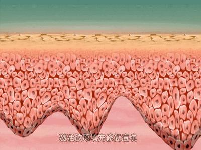 痘印痘坑真正祛除的方法,痘印痘坑去不掉怎么办