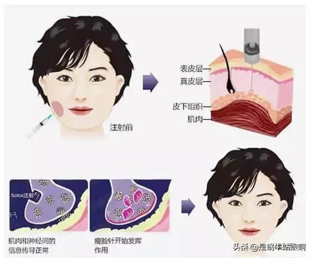 方脸咬肌大怎么快速消除,脸部咬肌大怎么瘦脸最有效