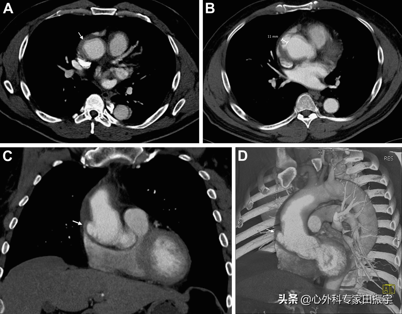 主动脉血肿危险期,高危脑动脉瘤破裂出血
