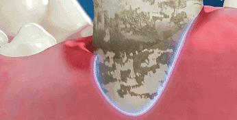 李沁牙膏真的有效果吗,李沁的黄牙变白了