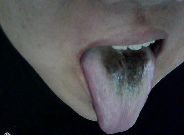 舌诊图解正常舌头是什么样的,观舌识病22种舌诊图解大全