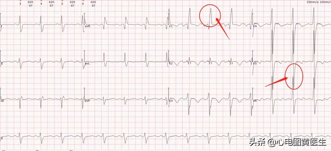 完全性右束支传导阻滞注意什么,完全性右束支传导阻滞如何解决