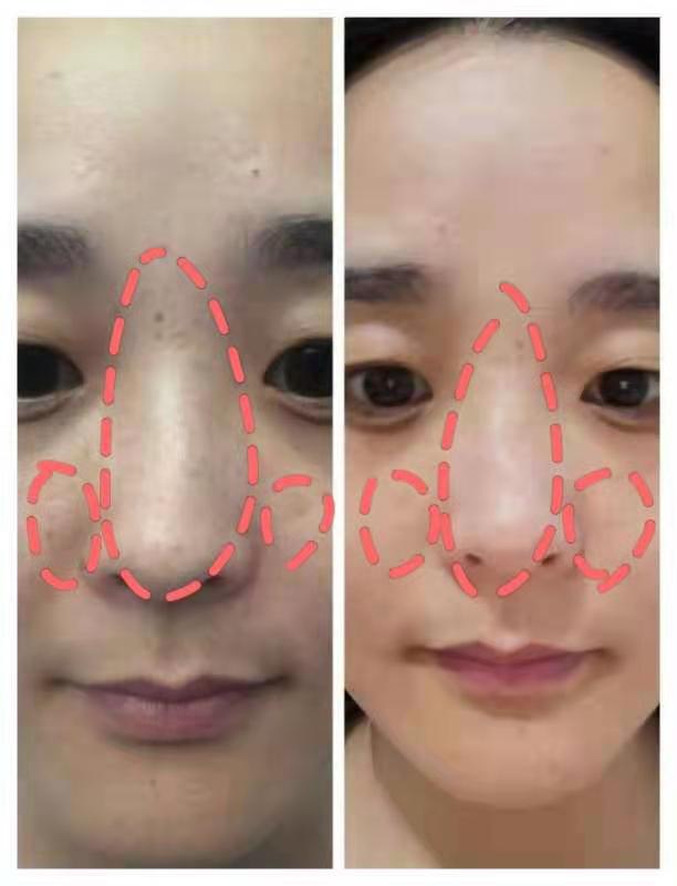 脸上有斑怎么祛斑最快速最有效果,脸上长斑最有效的祛斑方法