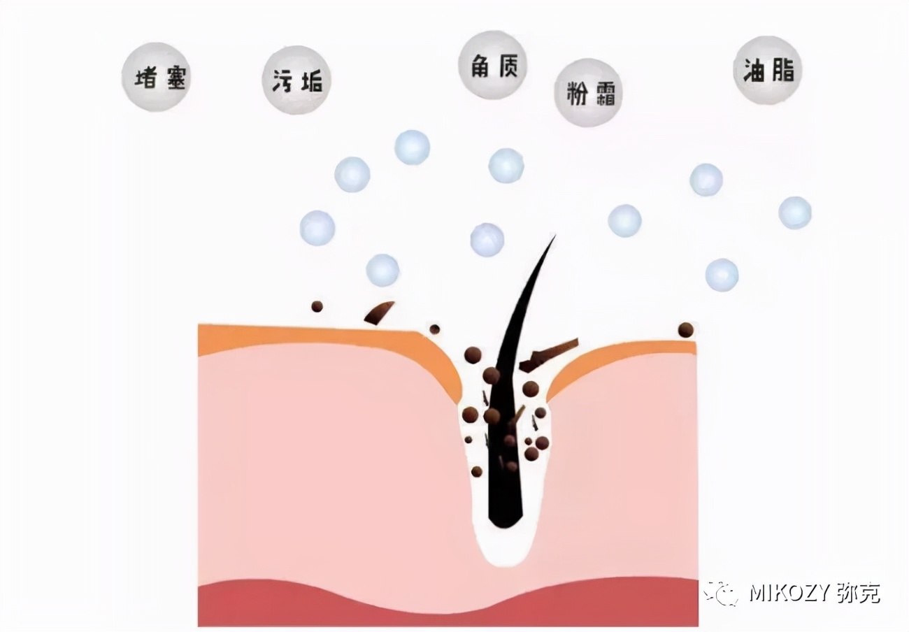 去除陈年深黑头,清理黑头哪家强