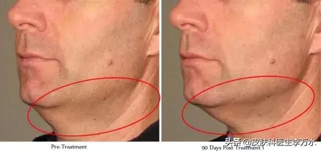 超声刀美容真的像张雨绮吗,张雨绮超声刀图片