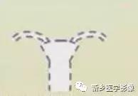 子宫发育异常，应想到的6大类常见畸形