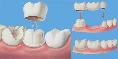 根管治疗后牙齿还是痛能戴牙冠吗,根管治疗后牙齿一定要戴牙冠吗