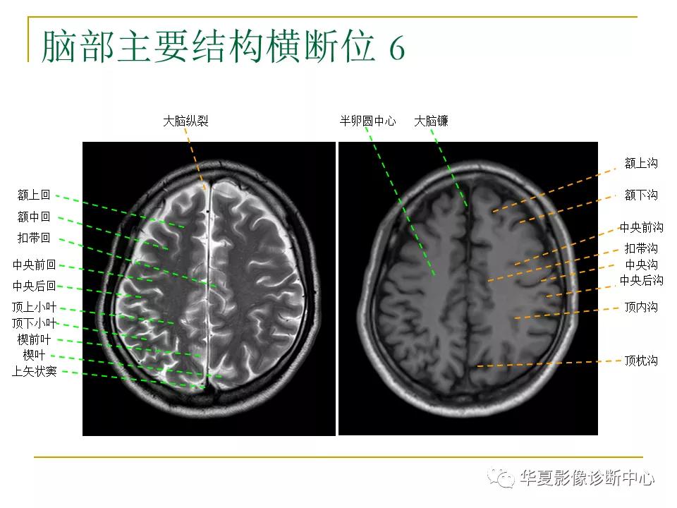 中国人脑立体定向mri应用解剖图谱,脑mri示意图