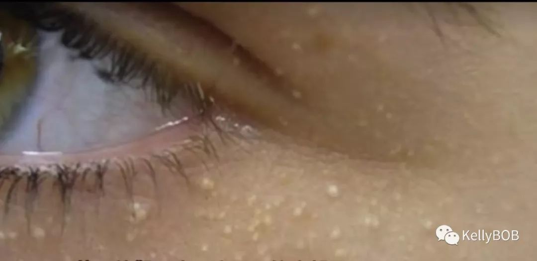 告别脂肪粒秘籍,去眼部脂肪粒最有效的方法