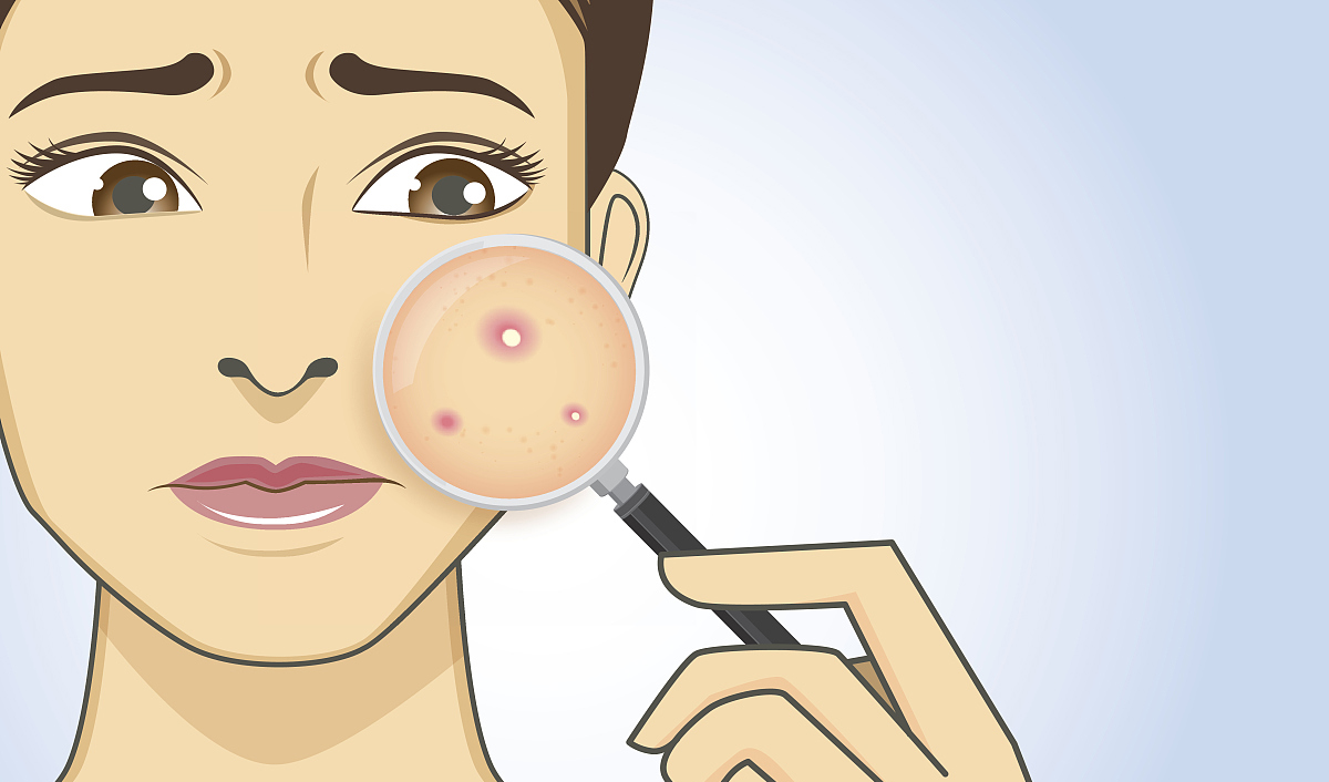 青春期额头闭口粉刺怎样去除,嘴角周围闭口粉刺怎么彻底去除