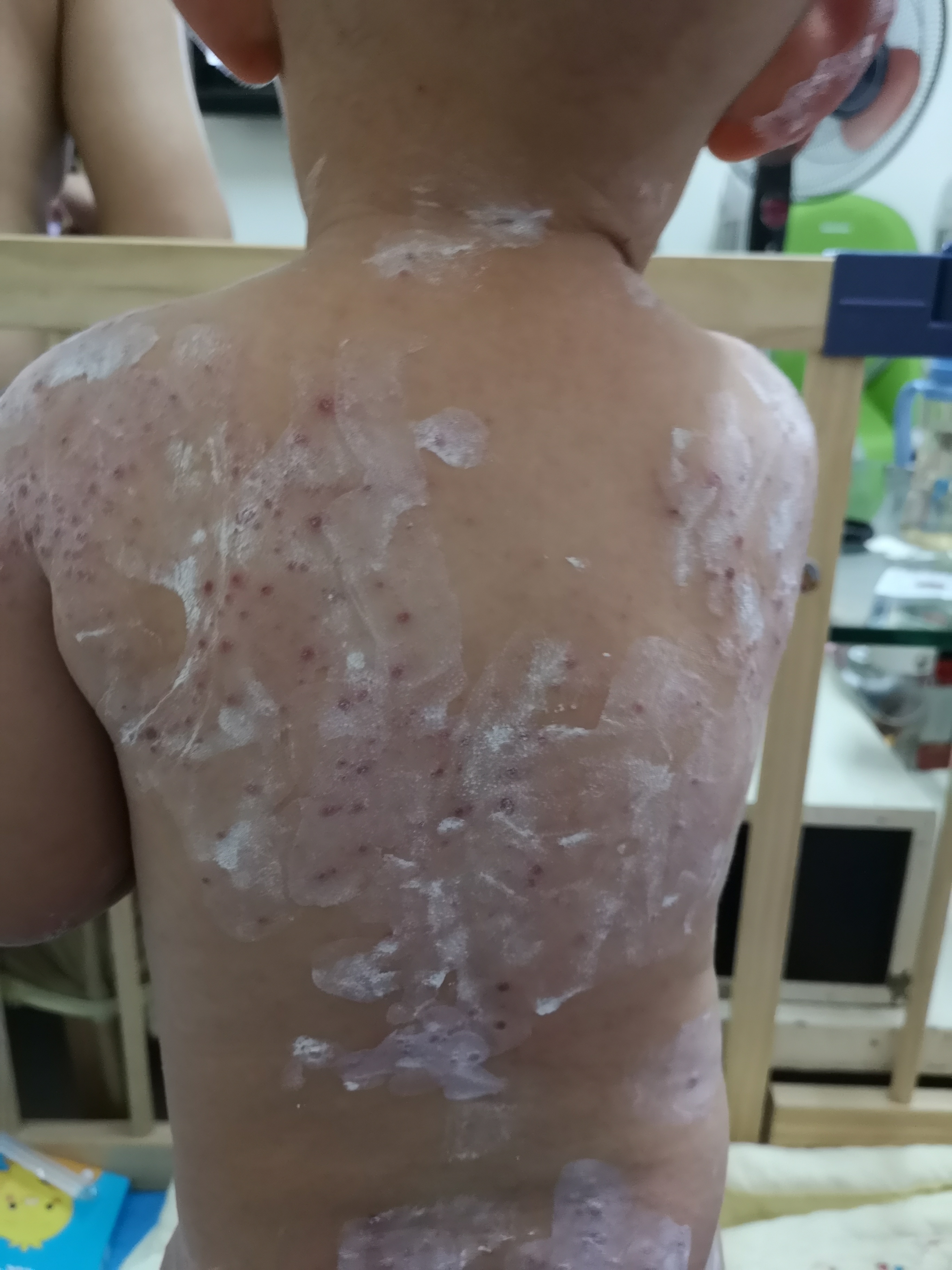 手足口病毒高发期,手足口高发期温馨提示