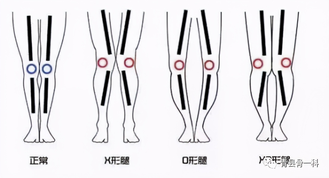 o型腿绑腿真的能矫正吗,o型腿绑腿能矫正过来吗