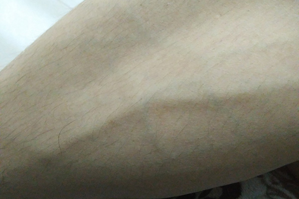 腿上青筋像蚯蚓怎么解决,腿上有蚯蚓一样的青筋是什么原因