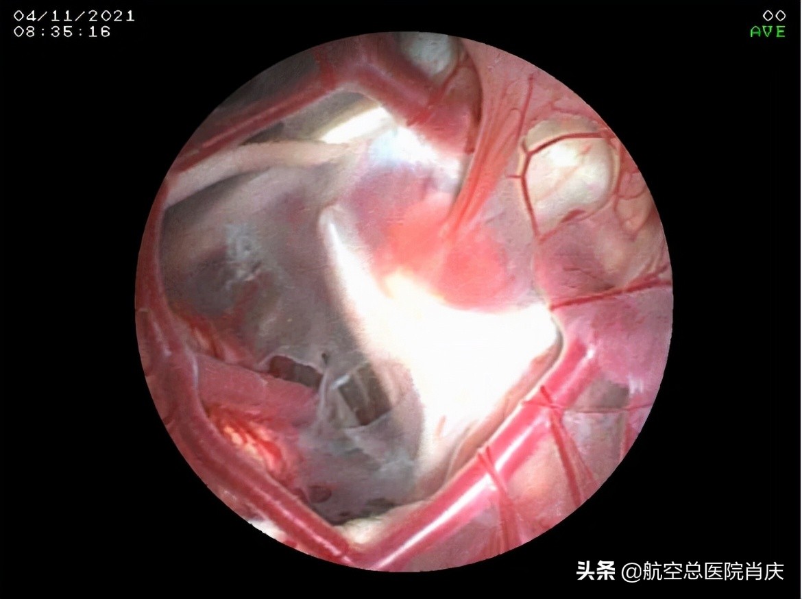 鞍上池蛛网膜囊肿手术费用,鞍上池蛛网膜囊肿影响智力吗