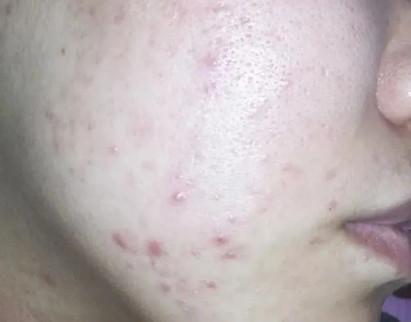 祛痘印最简单有效的方法是什么,去痘印最有效的方法值得收藏