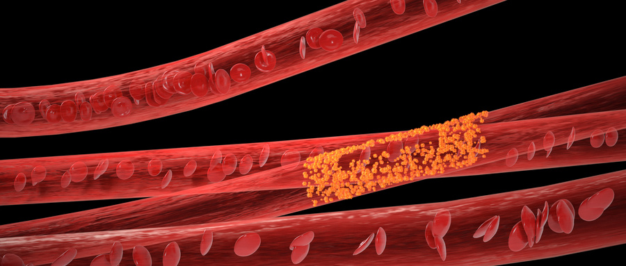 “颈动脉”被堵塞导致偏瘫，做“支架”还有意义吗？