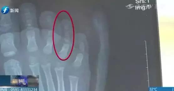 8岁女童被外卖车撞伤,小女孩被外卖员撞后续处理结果