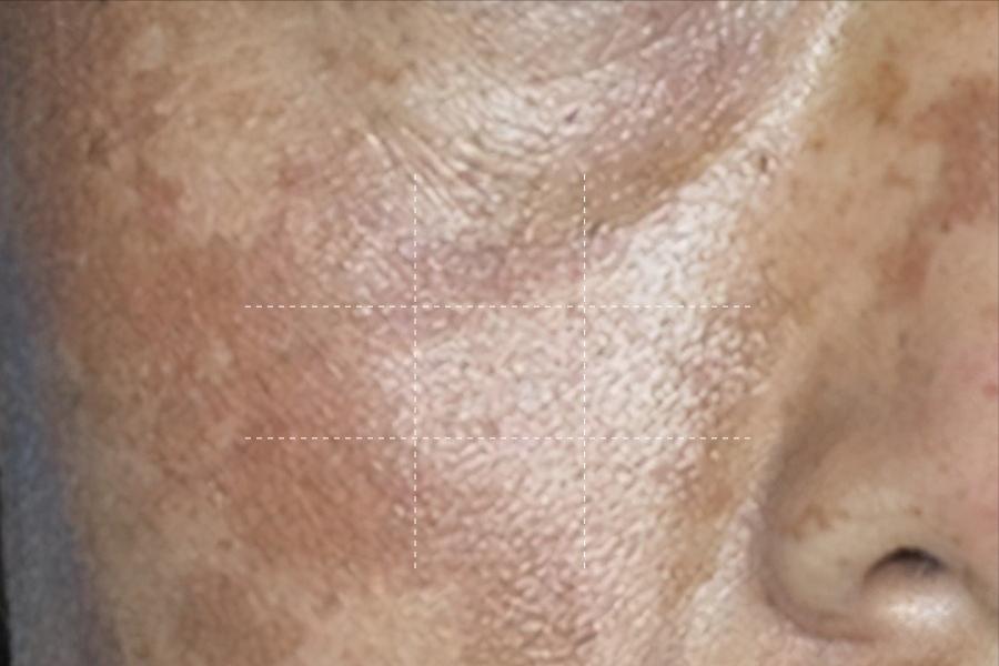 铅汞脸如何自救,那些被毁容的女孩