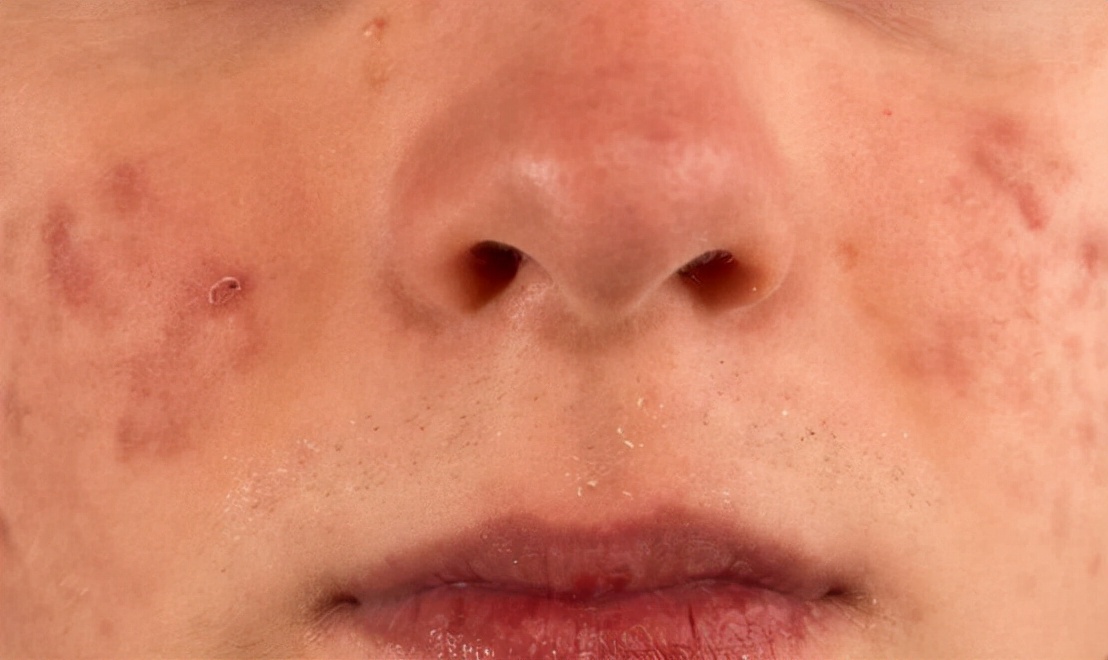 一直长痘留疤怎么办,长痘留疤怎么恢复