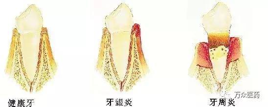 牙疼不是病疼起来真的要了半条命,牙疼不是病牙疼起来真的要人命