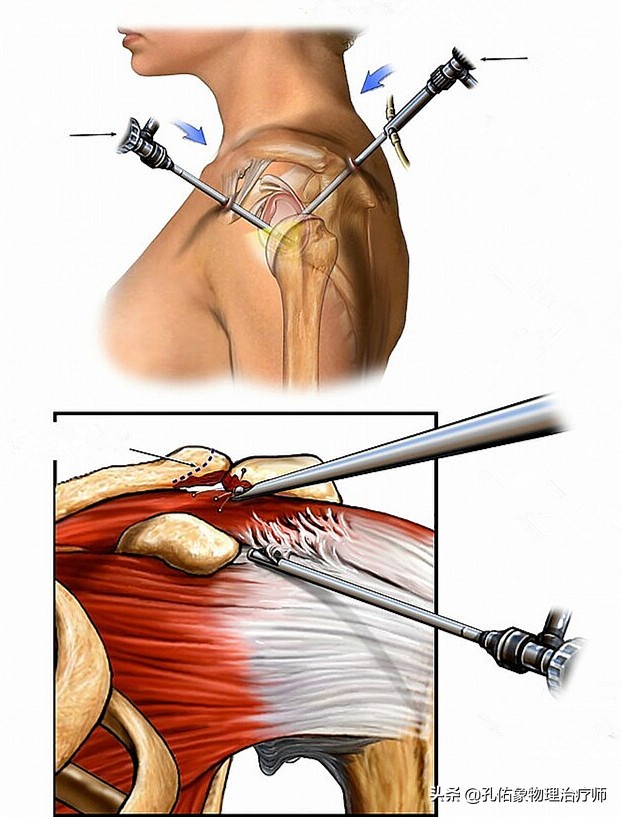 肩周炎肩膀疼痛用什么药,肩膀疼是肩周炎吗还是其他原因