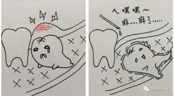 拔智齿能治脸歪吗,科普拔了智齿真的可以瘦脸吗