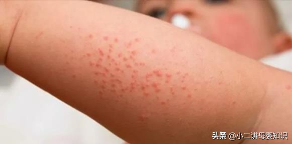 宝宝湿疹可以喝鸡鸭蛋膏吗,宝宝湿疹反复就是牛奶蛋白过敏吗