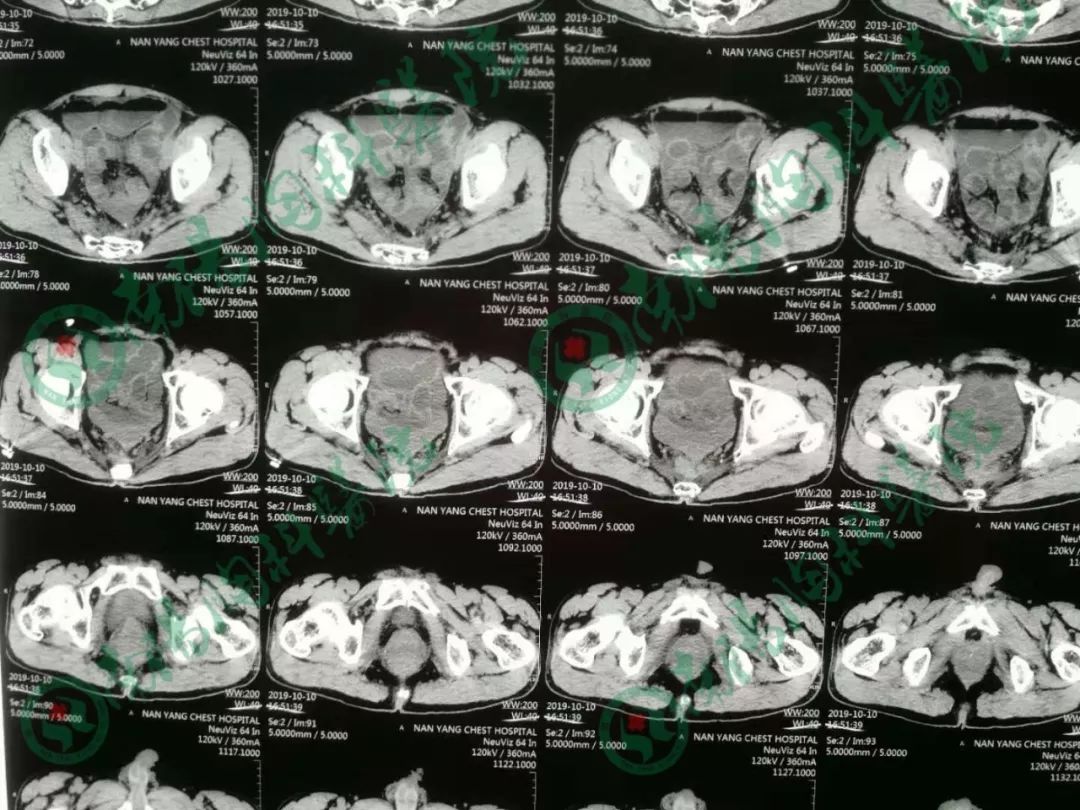 南阳胸科医院治疗直肠癌患者病例
