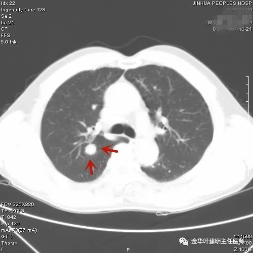 叶建明谈实性结节,叶建明肺实性良性结节会变癌症吗