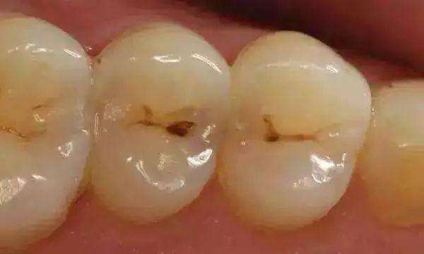 五岁小孩牙齿黑了怎么回事,3岁孩子牙齿突然变黑了怎么回事