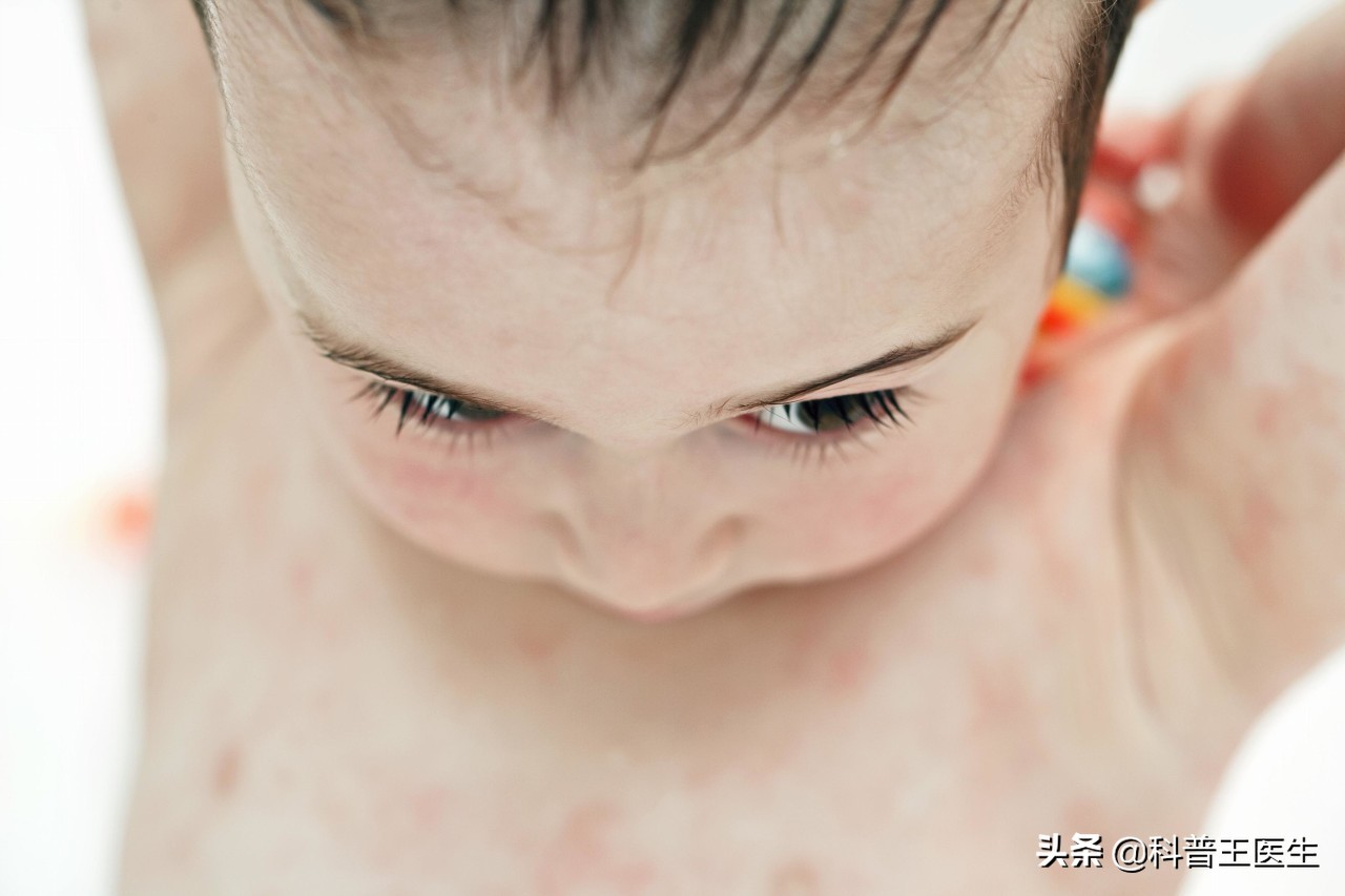 吃鱼为什么皮肤湿疹会加重,皮肤湿疹可以吃鱼吗