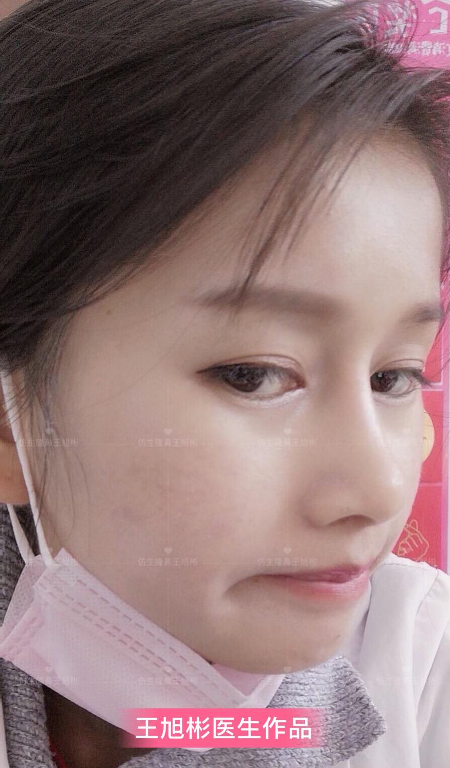 山根低鼻头大隆鼻,鼻根很低的隆鼻后的效果