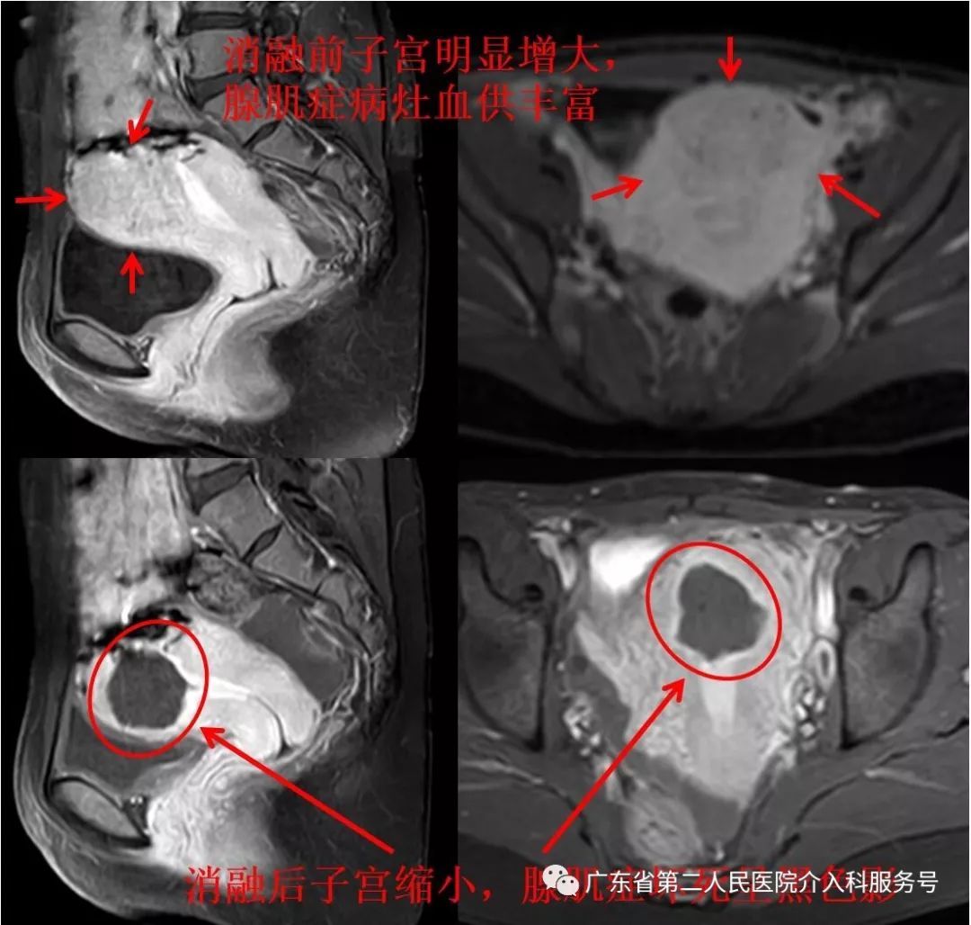 子宫腺肌症痛经伴有大小便也痛,子宫腺肌症痛经切除子宫能根治吗