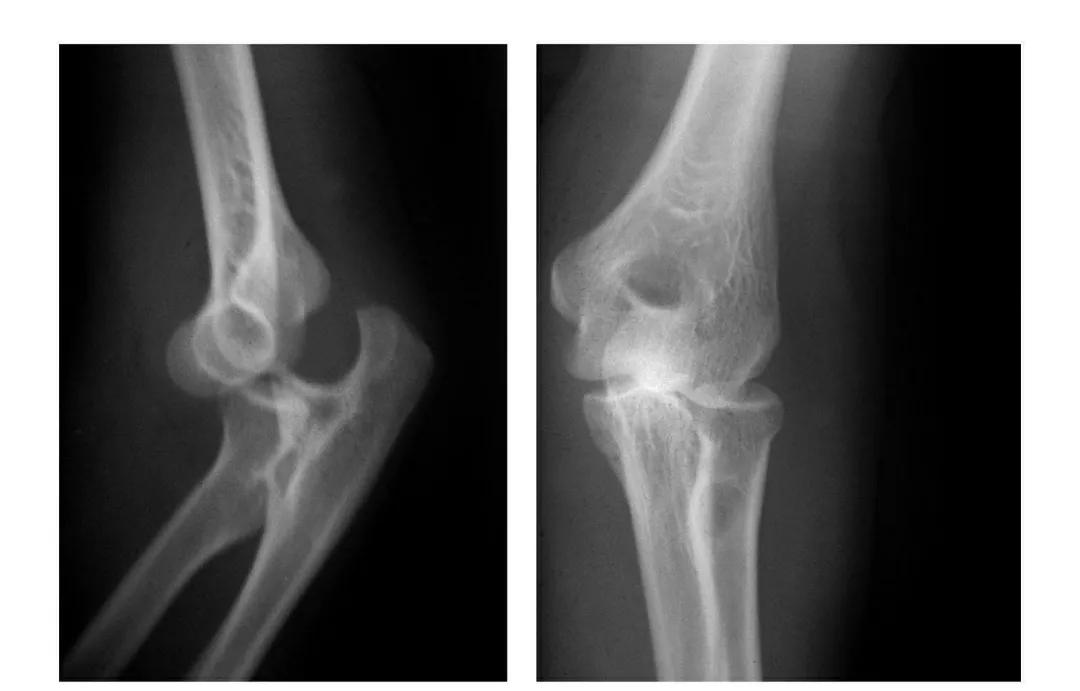 青少年肘部损伤最常见的是,肘部桡神经损伤的临床表现