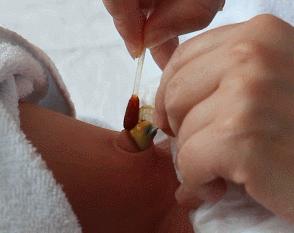 新生儿脐带消毒的正确方法,新生儿脐带消毒视频教程