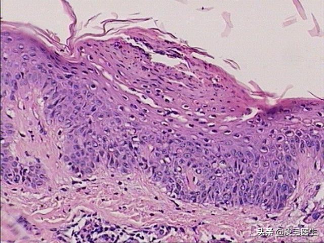 全身痒掉皮屑有什么征兆,浑身瘙痒发红是过敏了吗