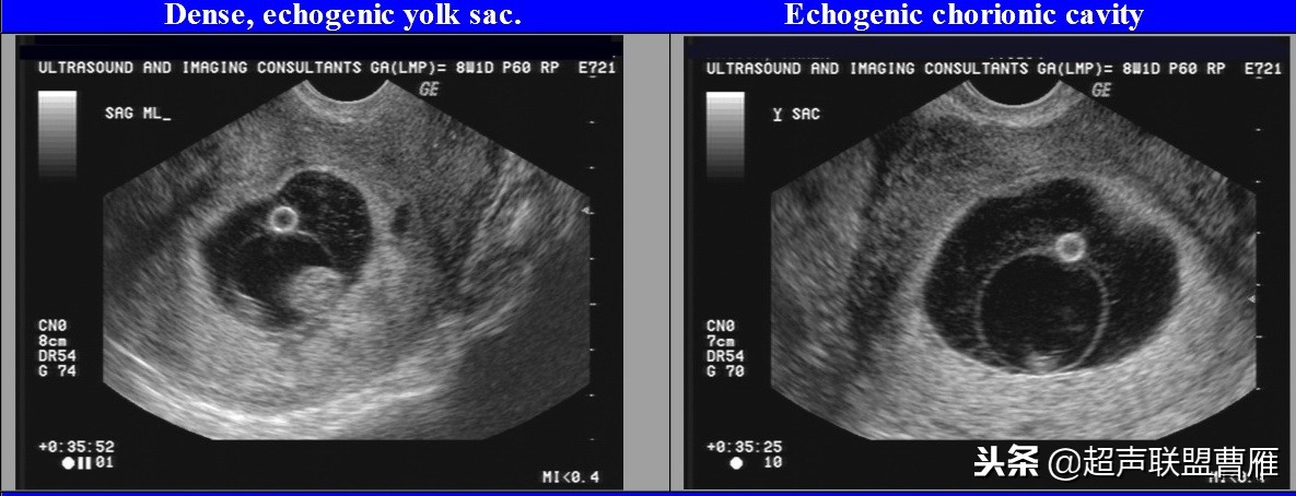 3毫米卵黄囊未见胎芽正常么,40多天的卵黄囊