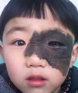 先天性黑毛痣可以不治疗吗,专家解析黑毛痣的病因是什么