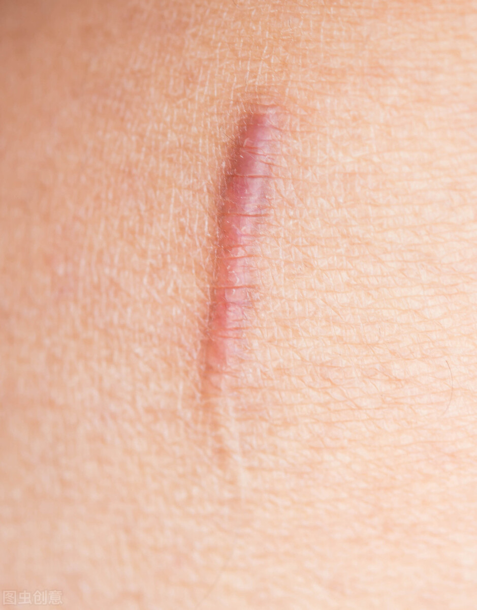 红色疤痕可以恢复到正常肤色吗,褐色的疤痕