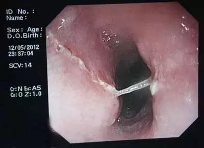 急救手册异物卡喉的唯一救命方法,异物卡喉一招可以救命视频教你