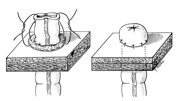中国100万造口人：改道的肠子，改变的人生