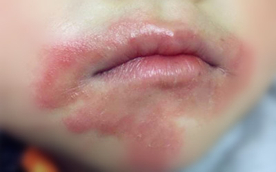 口水疹是什么原因引起的,一岁宝宝严重口水疹