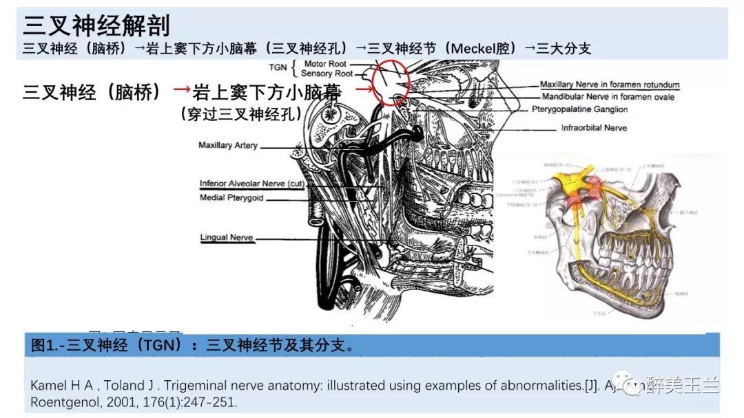病例分享丨三叉神经节微球囊压迫术的麻醉管理