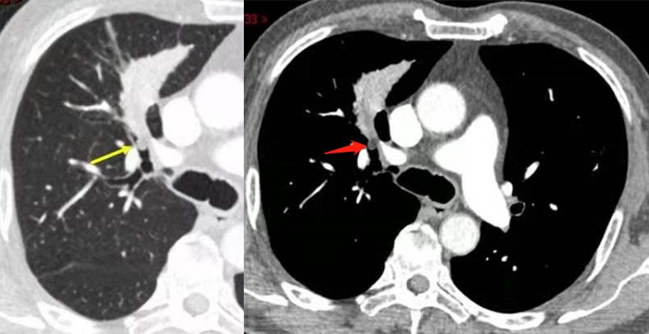 肺内见多发小囊状无纹理透光影,肺内肿块并厚壁空洞