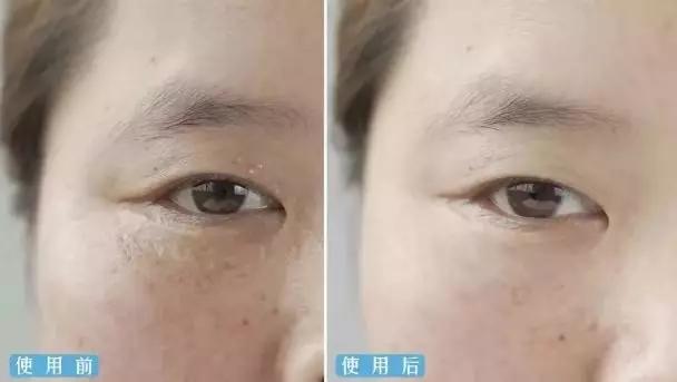 别再用针挑！用米澳拉，脂肪粒自己“掉”下来，效果胜过医美激光